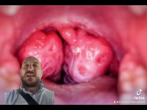 Cuidados Especiais com as Amígdalas: O Papel do Médico Especialista