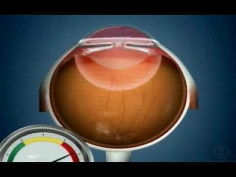 Causas do Glaucoma Ocular