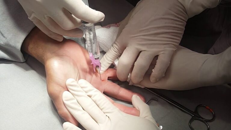 Cirurgia para Dedo em Gatilho no Polegar: Abordagens e Resultados