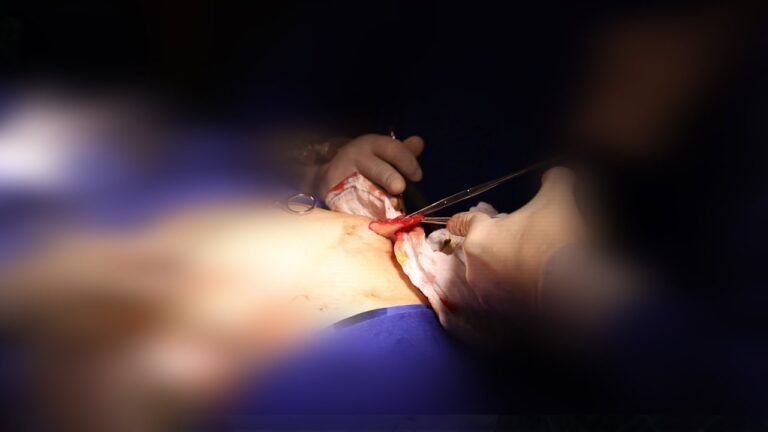 Cirurgia de Colelitíase: Abordagens e Resultados Eficazes
