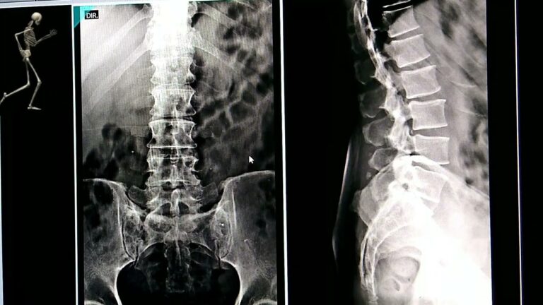 Identificando a Mancha no Raio X da Coluna Vertebral