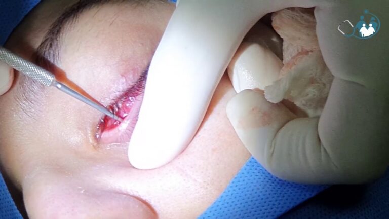 Dias de Atestado Necessários para Cirurgia de Calázio