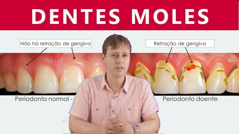 Mobilidade do Dente: Causas e Tratamentos Eficazes