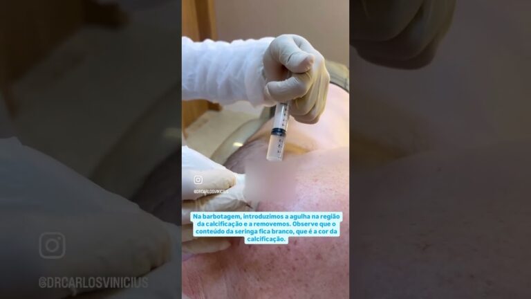 Entendendo a Tendinite Calcificada no Ombro: Causas e Tratamentos