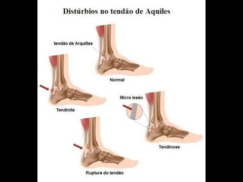 Entendendo a Tenossinovite no Pé: Causas e Tratamentos
