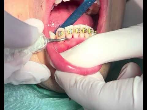 Raspagem Dental: Necessidade de Anestesia?