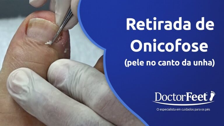 Pele embaixo da Unha do P&eacute;: Causas e Tratamentos Eficazes