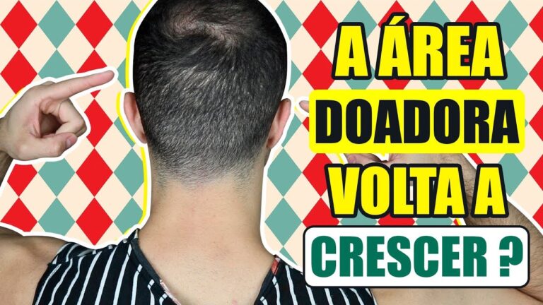 Crescimento da Área Doadora Após Transplante Capilar
