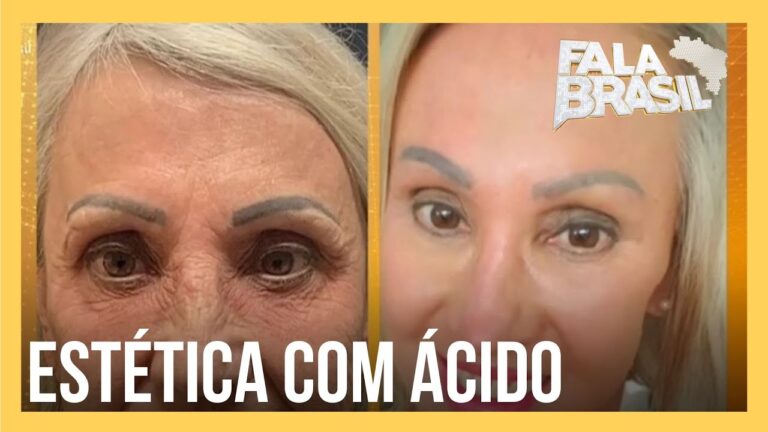 Peeling Preco: Benefícios e Técnicas Eficazes