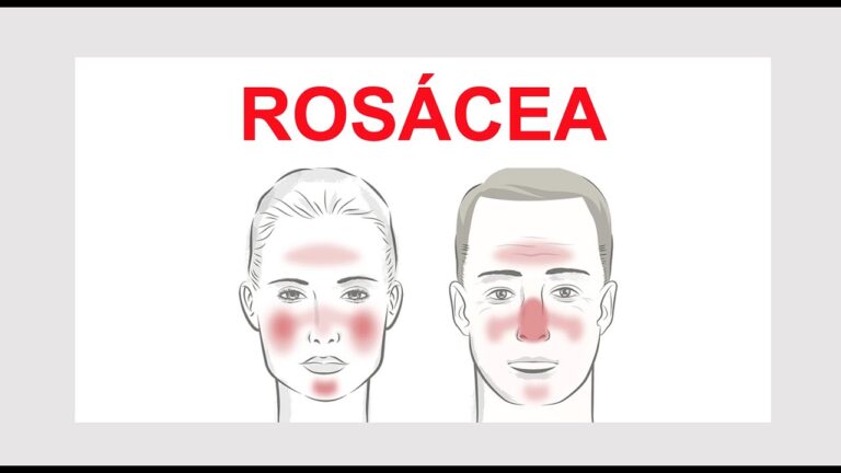 Tratamento Eficaz da Rosácea com Especialista