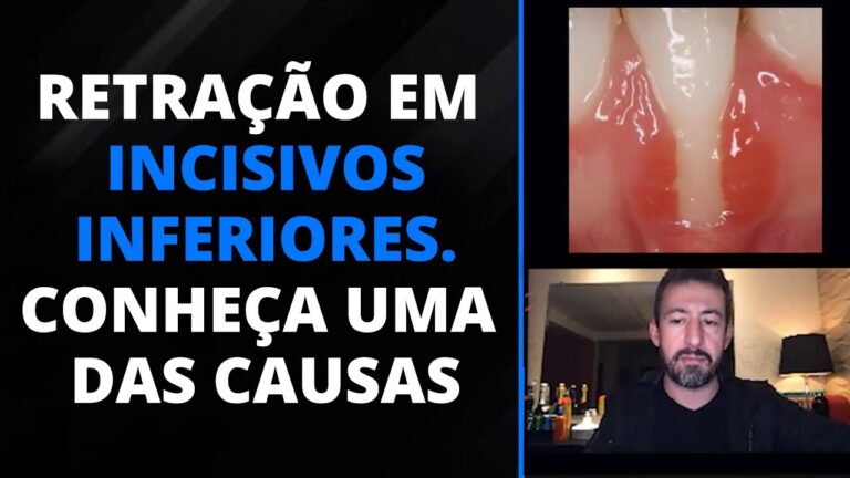 Entendendo a Retração Gengival Inferior: Causas e Tratamentos