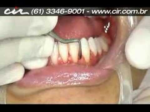 Importância da Limpeza Dental para a Saúde Bucal