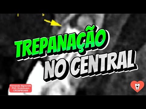 Dente Trepanado: Causas e Tratamentos Eficazes