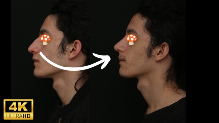 Transformações da Rinoplastia Masculina: Antes e Depois