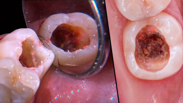 Causas e Tratamentos para Dente Furado do Lado