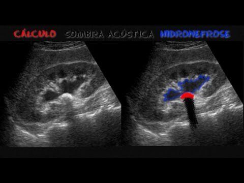 Ultrassom de Rim: Diagn&oacute;stico de Pedras Renais