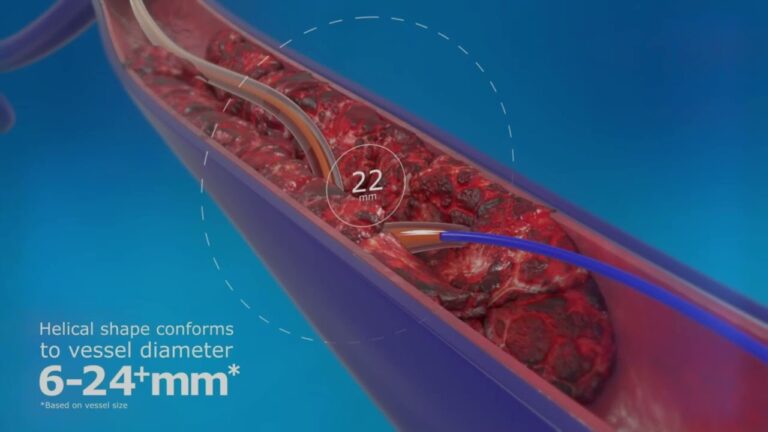 Avan&ccedil;os em Dispositivos M&eacute;dicos para Trombose Venosa Profunda