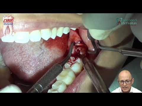 O Que Esperar ao Arrancar um Dente Siso