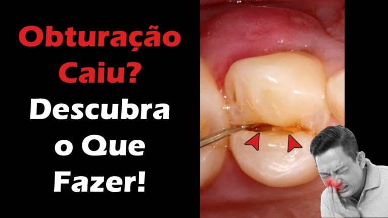 Dente Quebrado: O Que Fazer Após a Obturação Cair?