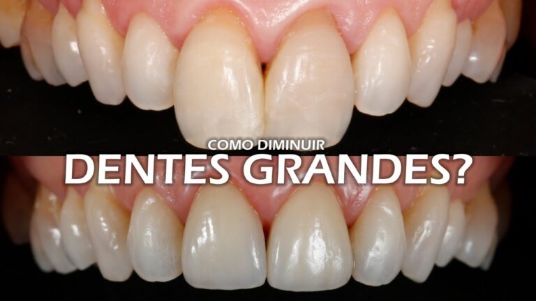 Impactos e Soluções para Dente Grande na Frente