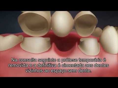 Ponte Fixa de 2 Dentes: Vantagens e Cuidados Essenciais