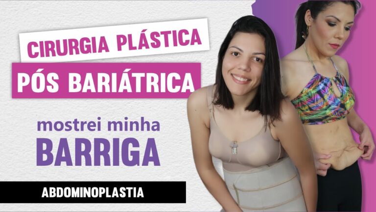 Transformações da Abdominoplastia Pós-Bariátrica: Antes e Depois