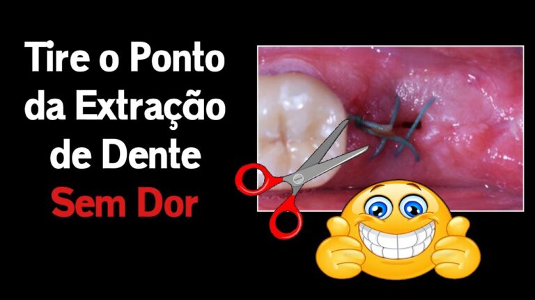 &Eacute; normal o dente cair ap&oacute;s 4 dias?