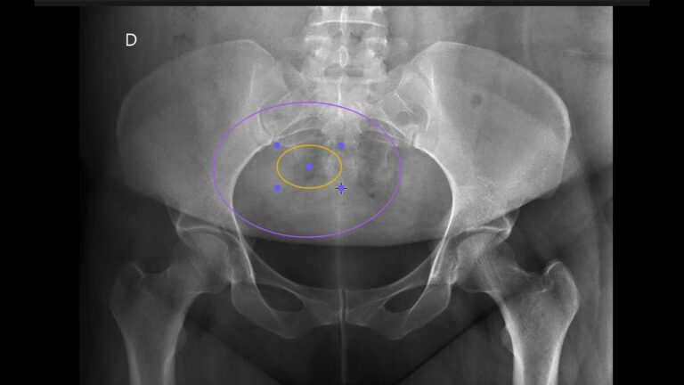 Cirurgia na Pelve Masculina: Avanços e Benefícios