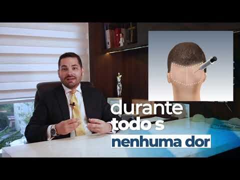 Implante Capilar: Tudo que Você Precisa Saber sobre o Doi