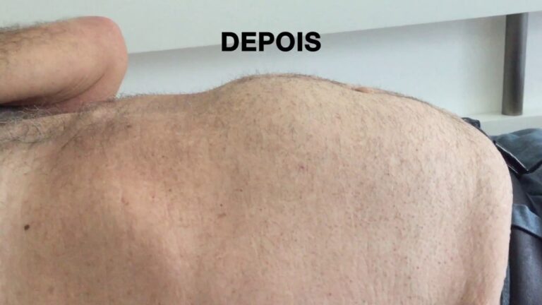 Transformações da Cirurgia de Hérnia Umbilical: Antes e Depois