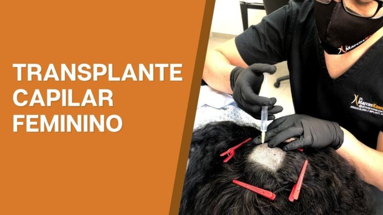 Transformações do Implante de Cabelo Feminino: Antes e Depois