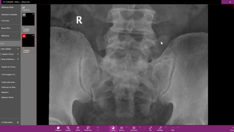 A Importância da Vértebra de Transição Lombossacra na Coluna Vertebral