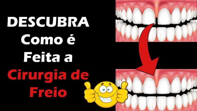 Frenectomia Lingual: Entenda o Preço e Benefícios