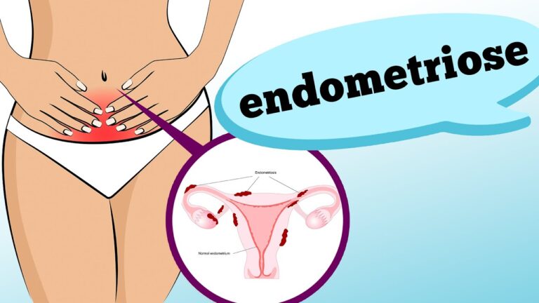 Como Reconhecer a Barriga de Quem Tem Endometriose