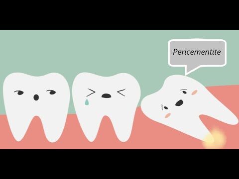 Aumento do Espaço Pericementário: Causas e Implicações Clínicas