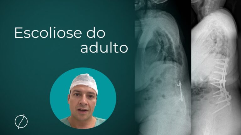 Avan&ccedil;os na Cirurgia de Escoliose Lombar