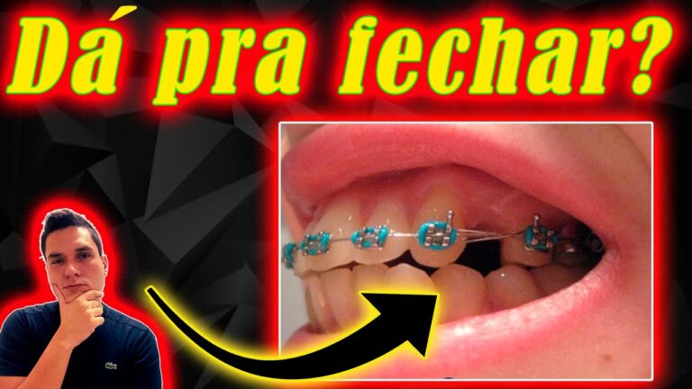Aparelho para Puxar o Dente para Frente: Benefícios e Vantagens
