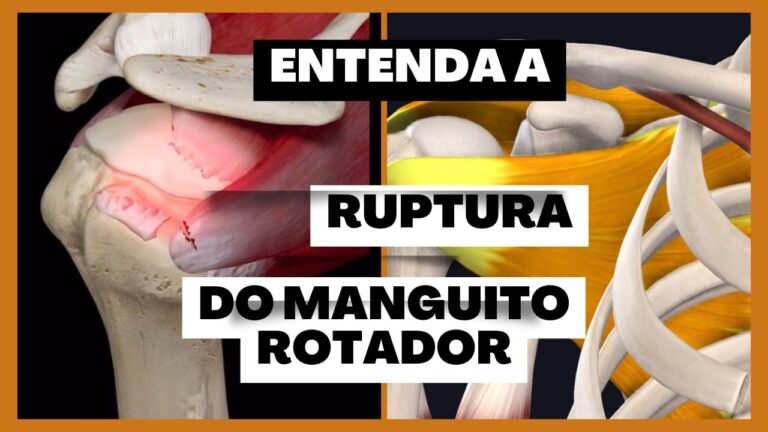 Ruptura de Tendão no Ombro: Causas e Tratamentos Eficazes