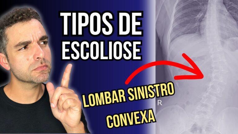 Escoliose Lombar: Compreendendo a Convexidade &agrave; Direita