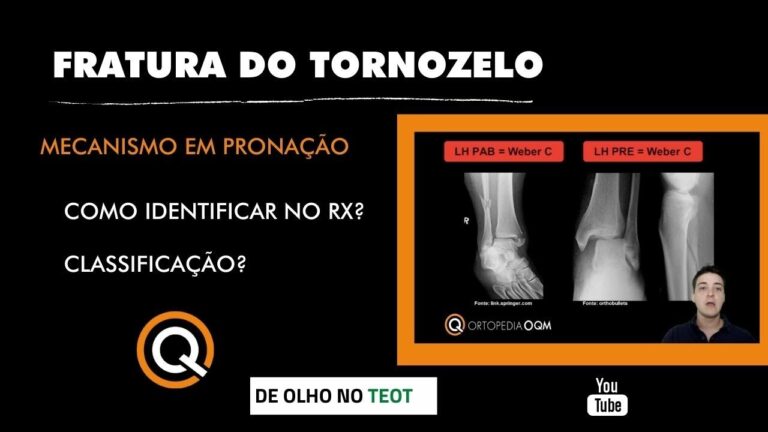 Tratamento Eficaz para Fratura do Tornozelo: RX e Reabilitação