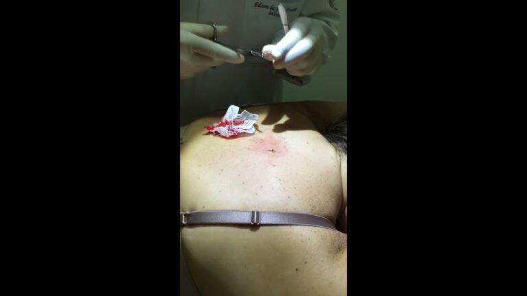 Tratamentos Eficazes para Remover Verrugas