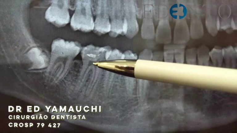 Raio X: Identificando Dentes que Precisam de Canal