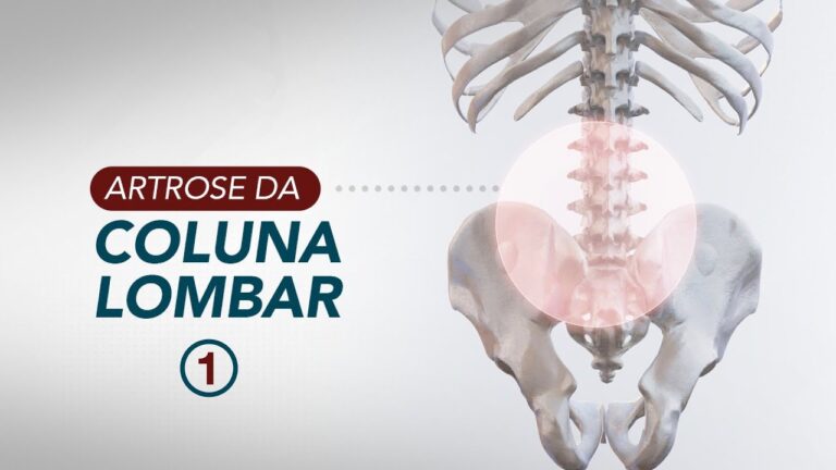 Artrose na Coluna: Imagens e Informações Essenciais