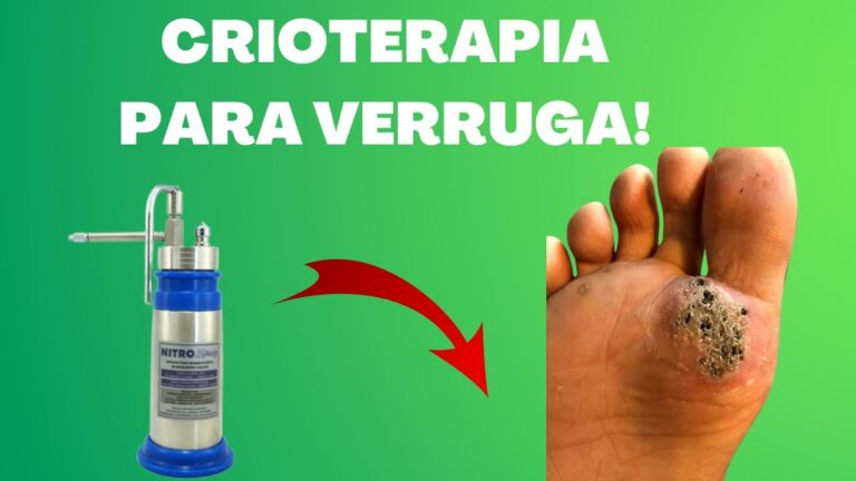 Resultados da Crioterapia em Verrugas: Antes e Depois