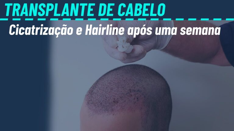 Recuperação e Resultados: 7 Dias Após o Transplante Capilar