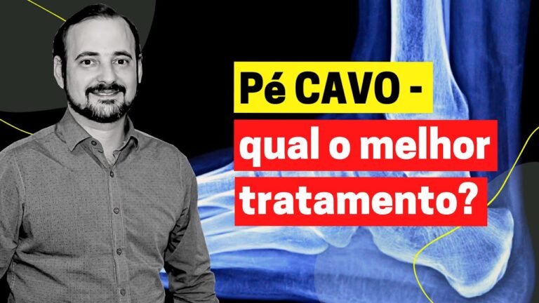 Tratamento Eficaz para Pés Cavos