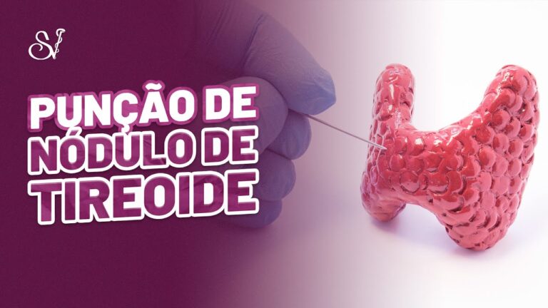 Puncão de Nódulo Tireoidiano: Indicações e Procedimentos
