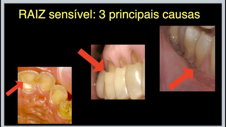 Sensibilidade na Raiz do Dente: O Que Fazer?