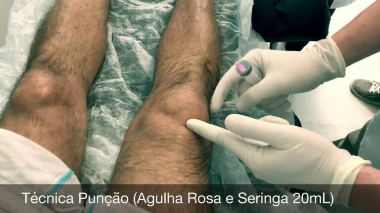 Recuperação Após Punção no Joelho: O Que Esperar