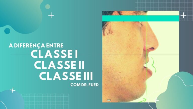 Correção de Dentes Inferiores para Frente: Soluções e Tratamentos